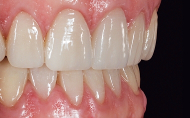Fig. 17: The efficiently fabricated veneers appeared absolutely natural.