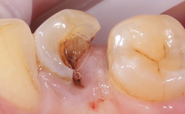 Fig. 1: Initial situation: Tooth 34 was severely damaged. Gingival tissue had overgrown into the cavity.