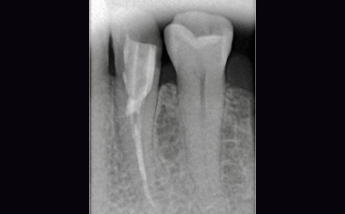 Fig. 2: Status following revision, pin setting and build-up filling.