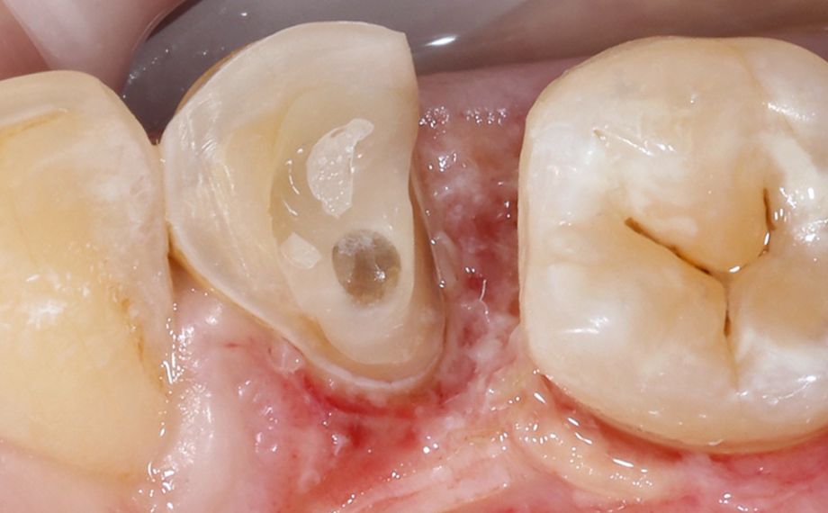 Fig. 3: Care was taken during the preparation not to leave any sharp edges in the cavity.