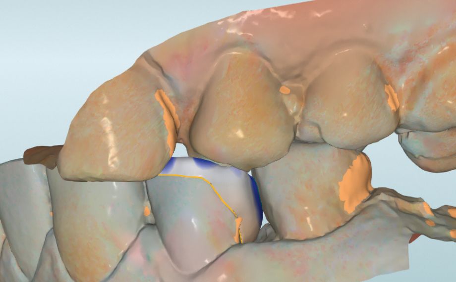 Fig. 7: The minimum layer thicknesses were maintained in the construction of the restoration.