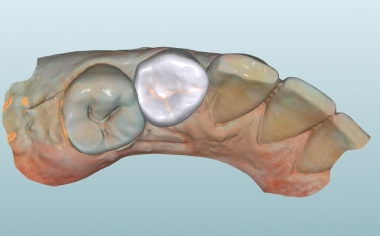 Fig. 8: The virtual endocrown in the CAD software from the occlusal view.