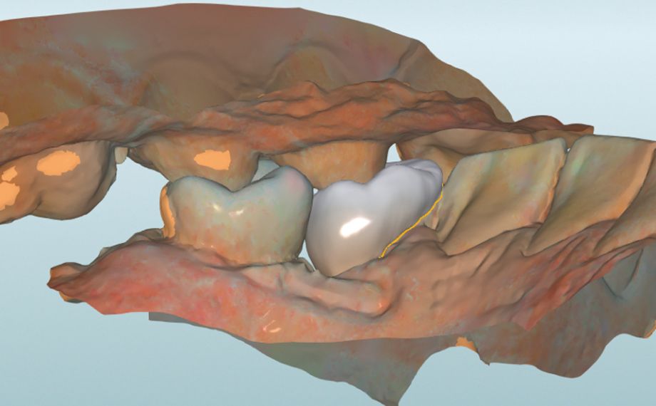 Fig. 9: The construction in the lingual view.