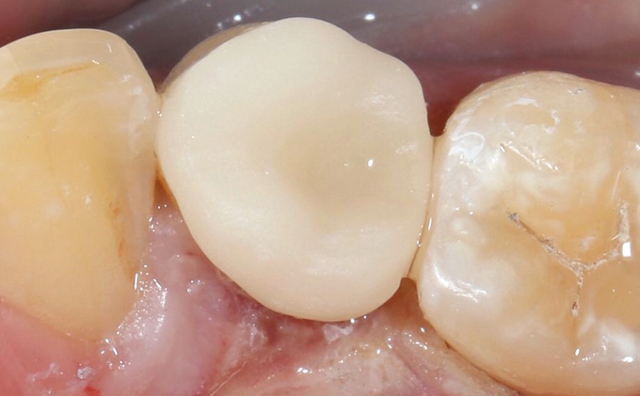 Fig. 11: The feldspar ceramic restoration during the clinical try-in.