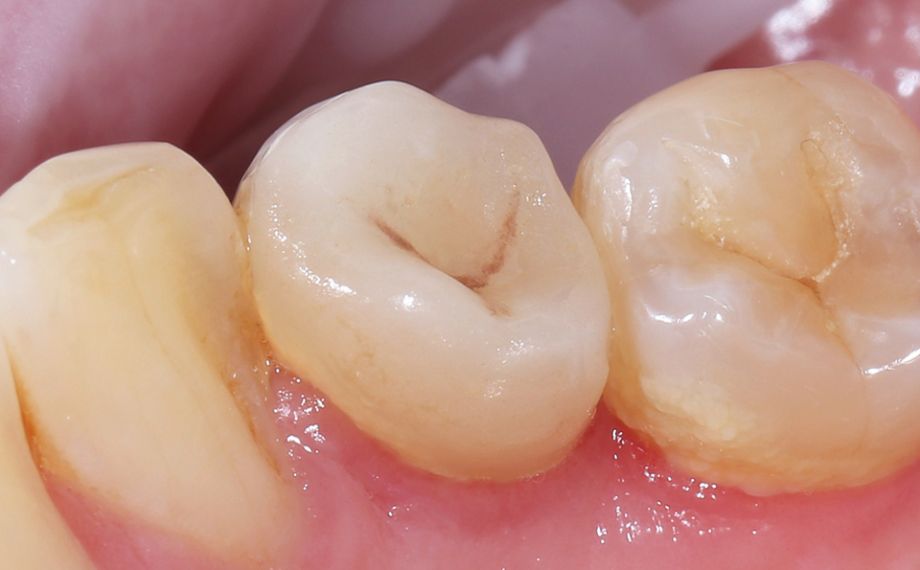 Fig. 14: Result: The highly esthetic integration of the restoration at the time of follow-up after six months.