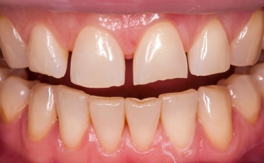 Fig. 1: The initial situation with diastemata and incisal edge fracture on tooth 21.