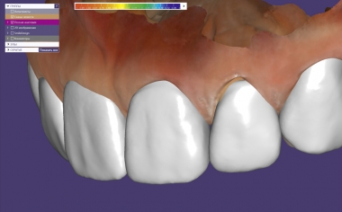 Fig. 3: The virtual smile design helped design a digital mock-up in the exocad software.