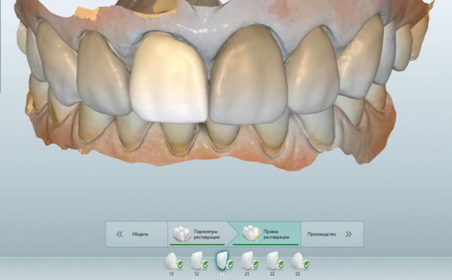 Fig. 7: The intraoral mock-up was scanned with the MyCrown System.
