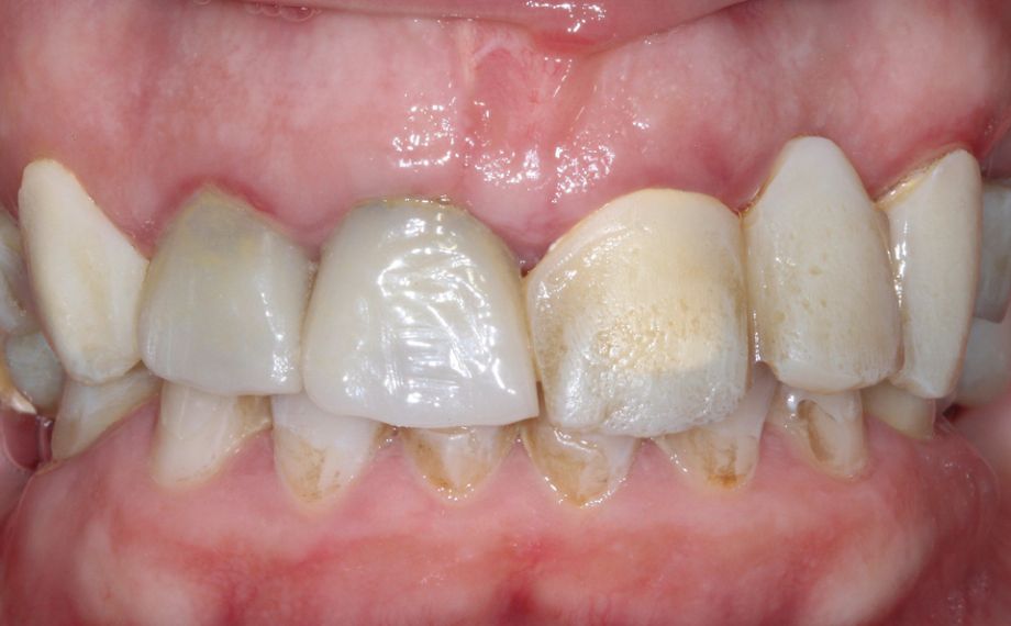 Fig. 1: The initial situation with multiple temporary restorations.