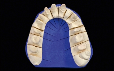 Fig. 2: Master models were created based on the impressions.