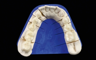 Fig. 5: The two bridge frameworks in the lower jaw prior to the framework try-in.
