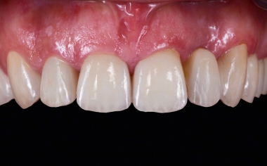Fig. 8: Result: The restorations harmonized in shape and shade with the natural tooth substance.