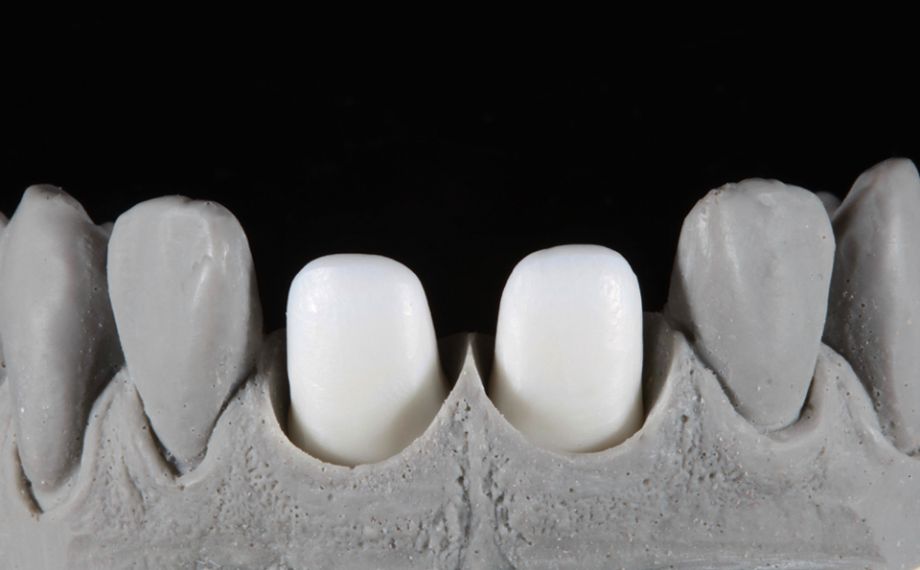 Fig. 1: Framework structures at tooth 11 and 21 made of the zirconia VITA YZ HT.