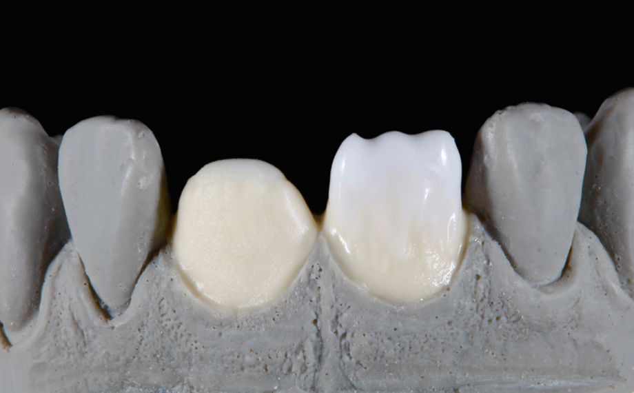 Fig. 3: EFFECT LINER 4 (yellow) was applied in the cervical area and EFFECT LINER 1 (white) in the incisal area as the foundation.