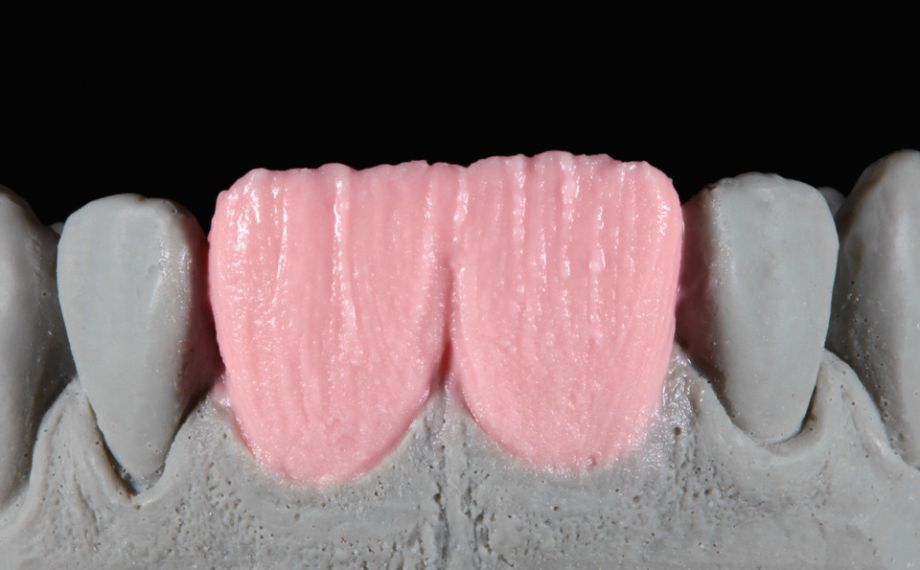 Fig. 5: The dentine core was layered with BASE DENTINE A2.