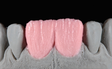 Fig. 5: The dentine core was layered with BASE DENTINE A2.