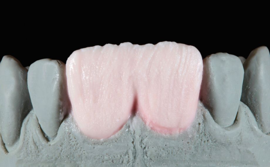 Fig. 6: The dentine core was modified with TRANSPA DENTINE.