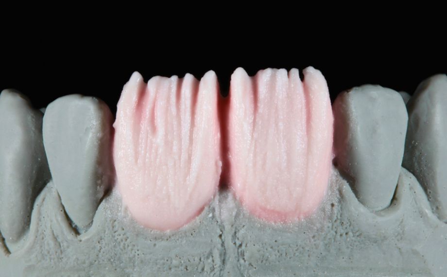 Fig. 7: In order to ensure an incisal light transmission in some places, an anatomical cut-back was used.