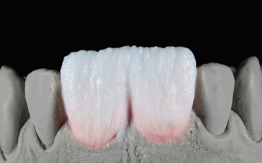 Abb. 9: The crowns were then completely coated with ENAMEL light.