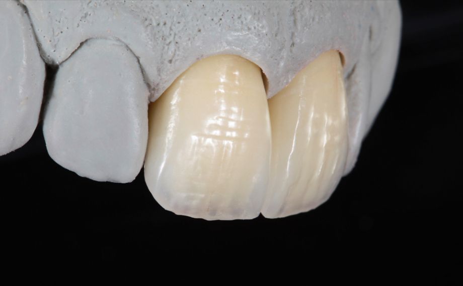 Fig. 12: After the finalization and glazing, the crowns had an absolutely natural effect.