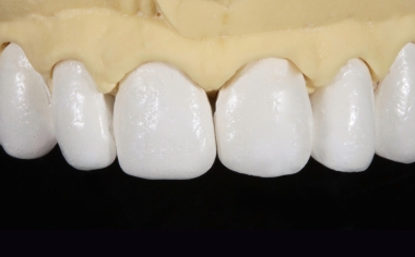Fig. 3: The master model with refractory stumps and anatomically reduced veneers after dentine firing.