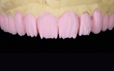 Fig. 4: The cut-back after the application of DENTINE A1 over the entire surface.