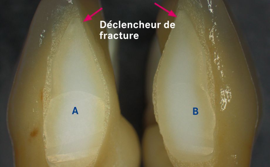 Fig. 1a : Pour des raisons esthétiques, l’armature a été séparée entre les 31 et 41 après frittage.