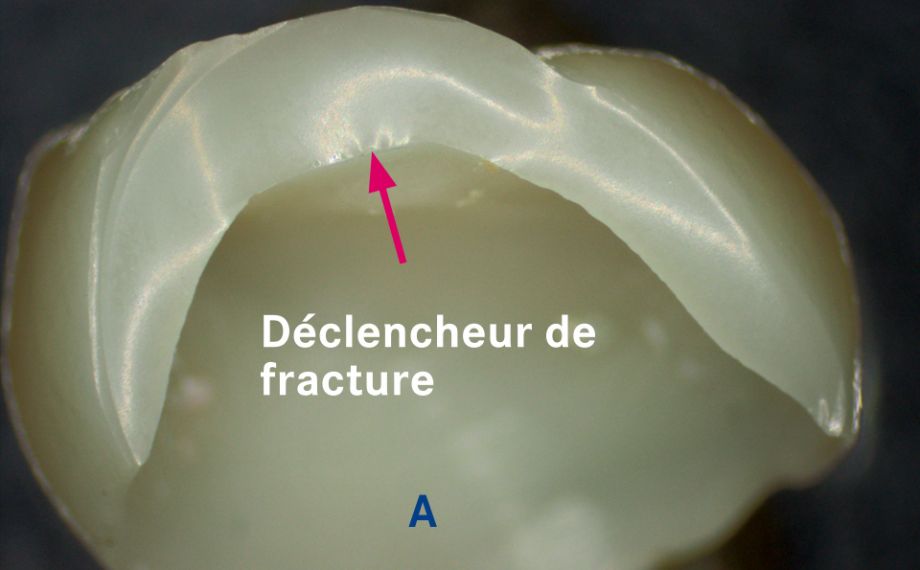 Fig. 2a : Couronne en vitrocéramique fracturée après la cuisson de glaçage.