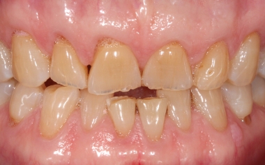 Fig. 2 : Les multiples récessions ont conduit à une ligne gingivale irrégulière.