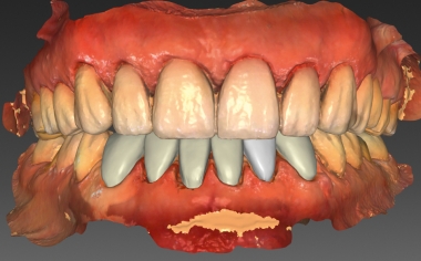 Fig. 9 : La construction virtuelle des facettes mandibulaires.