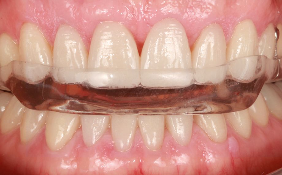 Fig. 14 : Une gouttière guidant les dents antérieuresa été posée après la reconstitution totale.