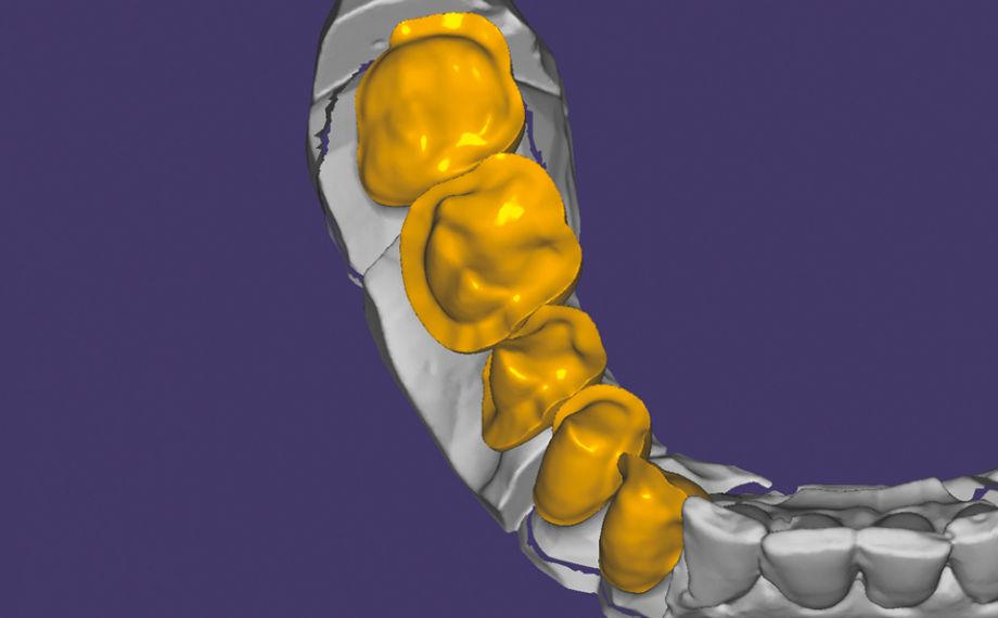 Fig. 3 : Sur l’armature en dioxyde de zirconium fabriquée par CFAO ont été conçues les structures cosmétiques en céramique hybride.