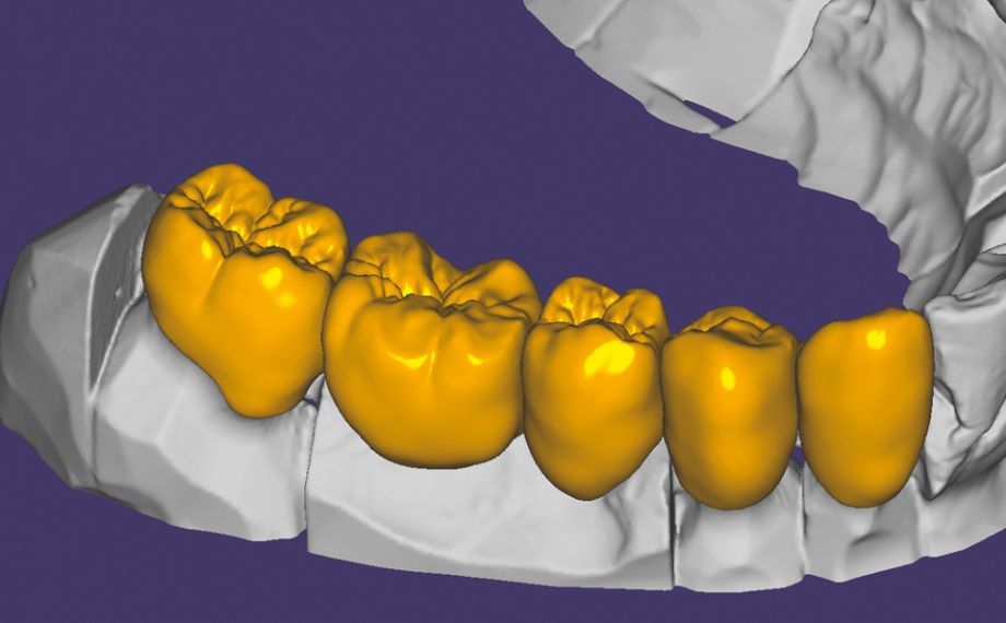 Fig. 4 : Grâce à la faible épaisseur minimale de paroi de la céramique hybride (jusqu’à 0,2 mm), la morphologie paraît très naturelle.