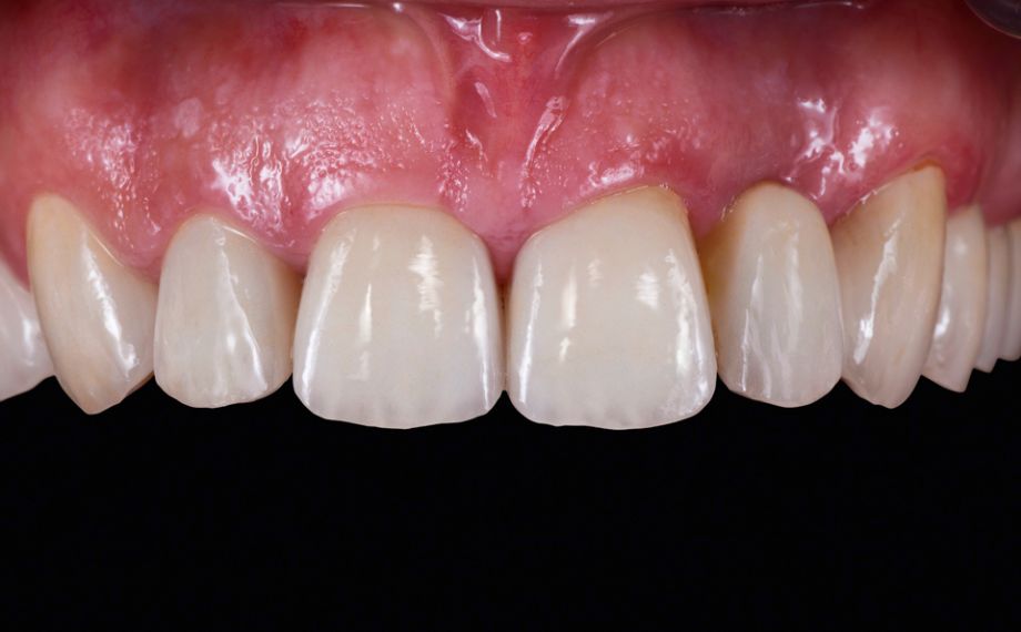 Fig. 8 : Résultat : Les restaurations harmonisaient en forme et en couleur avec la substance naturelle des dents.