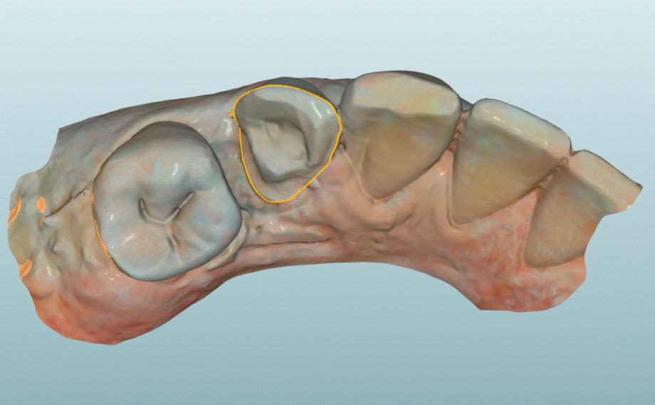 Fig. 5 : La limite de préparation a été établie après un scannage intra-oral.