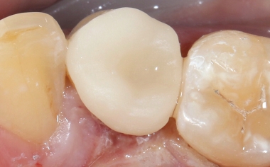 Fig. 11 : La restauration en céramique feldspathique lors de l’essayage clinique.