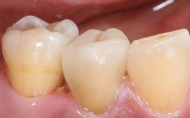 Fig. 12 : Aucune transition entre la restauration et la dent n’était visible, côté vestibulaire.