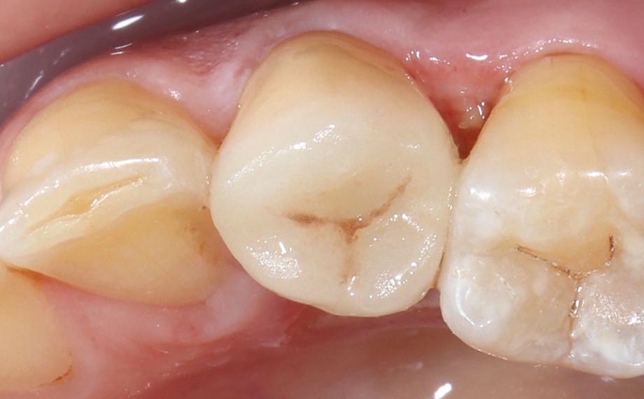 Fig. 13 : Vue occlusale sur l’endo-couronne posée par adhérence totale.