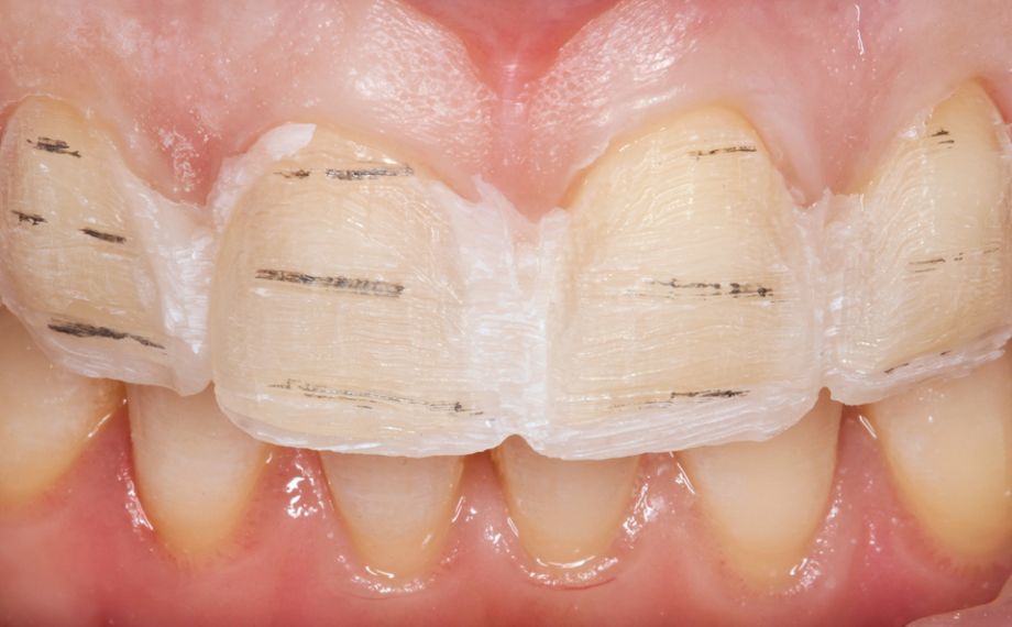 Fig. 9 : Une préparation contrôlée et la moins invasive possible a pu ainsi être réalisée.