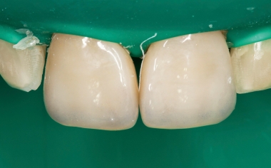 Fig. 14 : Après le conditionnement à l’acide fluorhydrique et au silane, la pose des facettes par collage complet était possible.