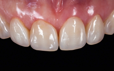 Fig. 15 : Les facettes s’intègrent dans les arcades dentaires naturelles.