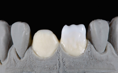 Fig. 3 : La base a été réalisée en EFFECT LINER 4 (jaune) cervical et en EFFECT LINER 1 (blanc) en zone incisale.