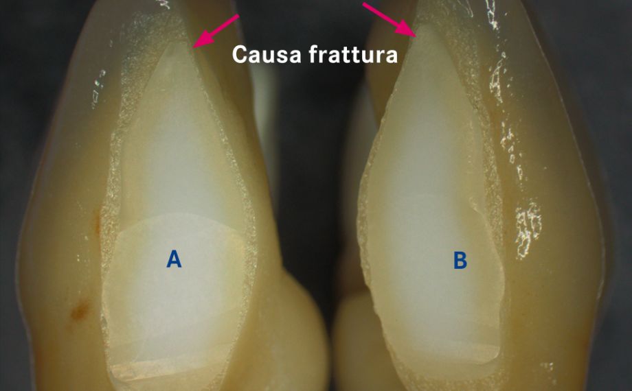 Fig. 1a: Per motivi estetici la struttura è stata separata tra 31 e 41 dopo la sinterizzazione.