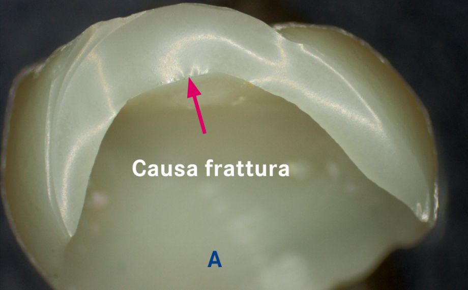 Fig. 2a: Corona in vetroceramica fratturata dopo la cottura finale.