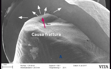 Fig. 2b: Un perno ceramico „sinterizzato“ con la corona, al toglimento del restauro ha causato un danno superficiale