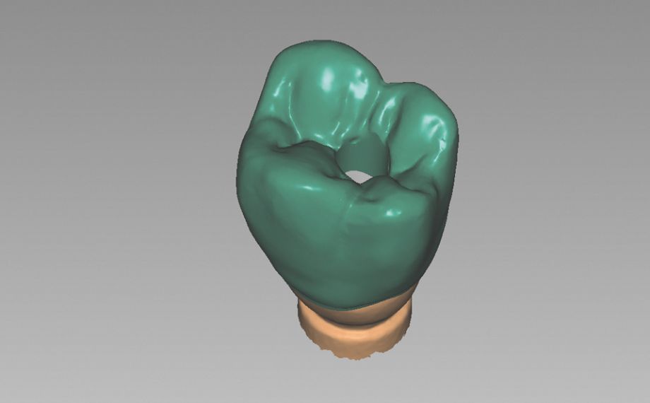 Fig. 6: Con il CAD-Software è stata progettata una corona-abutment con canale di avvitamento.