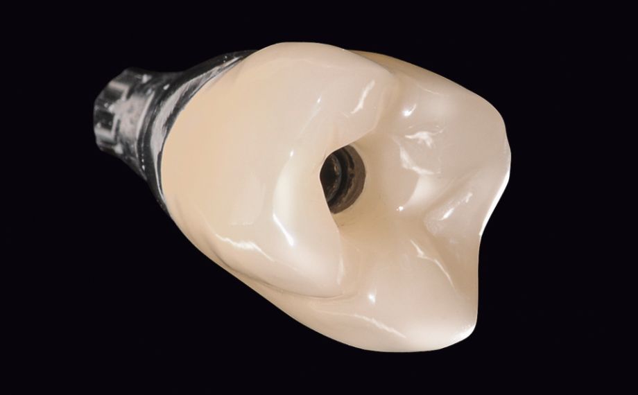 Fig. 8: Corona-abutment fissata con tecnica adesiva sull’abutment individuale.