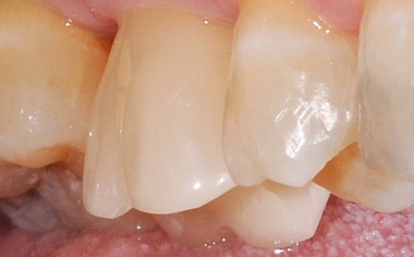 Fig. 11: Risultato: La corona-abutment si integra armoniosamente nella dentatura naturale residua.