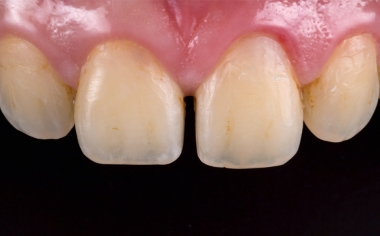 Fig. 1: Situazione iniziale: Giovane paziente con diastema tra 11 e 21.