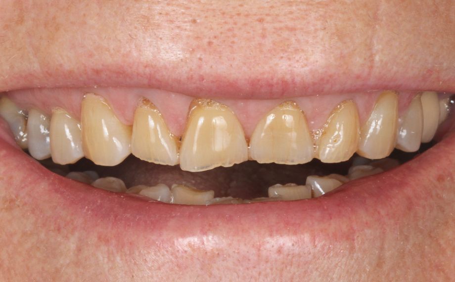 Fig. 1: Situazione iniziale: A seguito di abrasione ed erosione si era creato un andamento irregolare del bordo incisale.